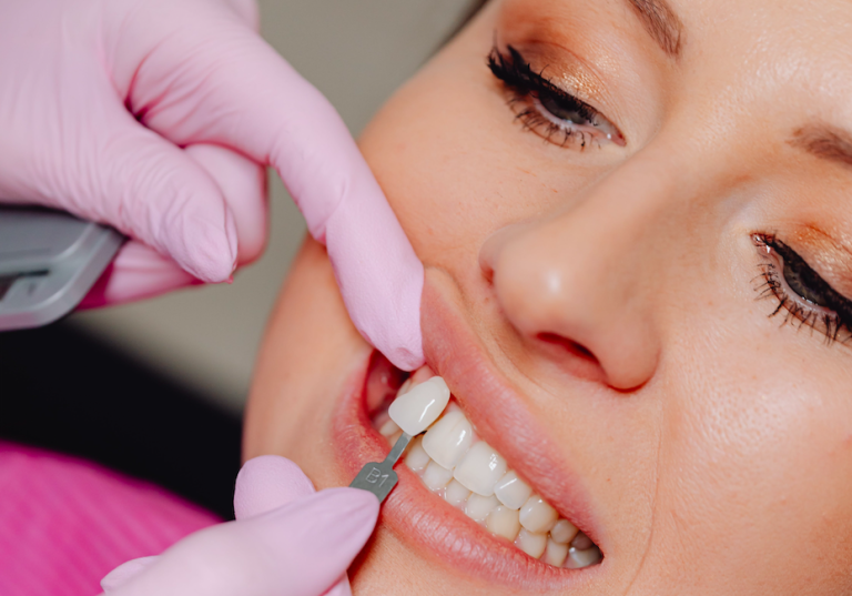 Come migliorare l’estetica dei denti?