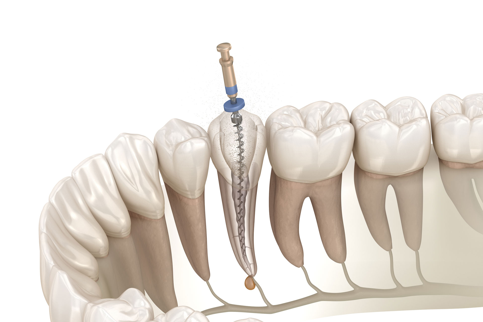 endodonzia cura canalare dentista dental extra 1