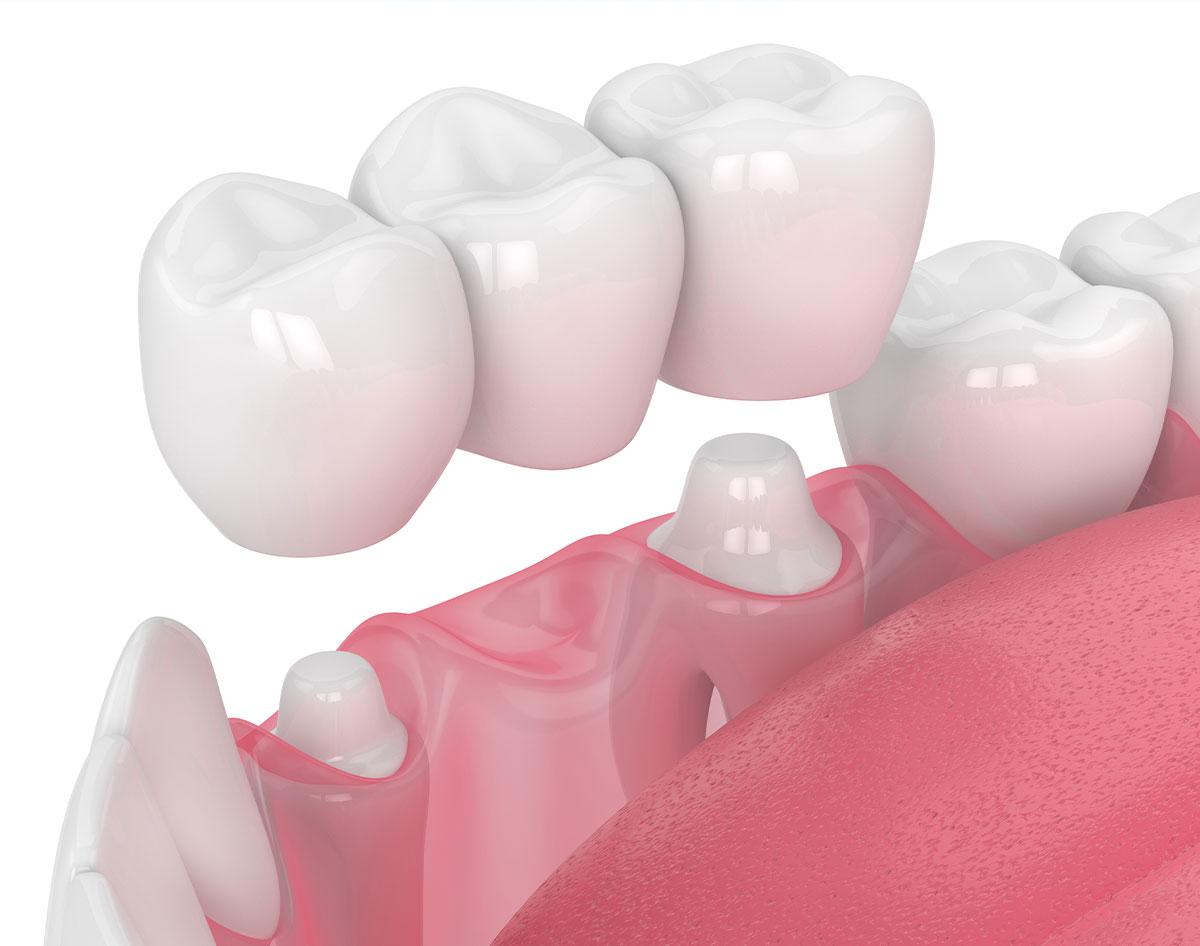ponte denti naturali dental extra dentista 1