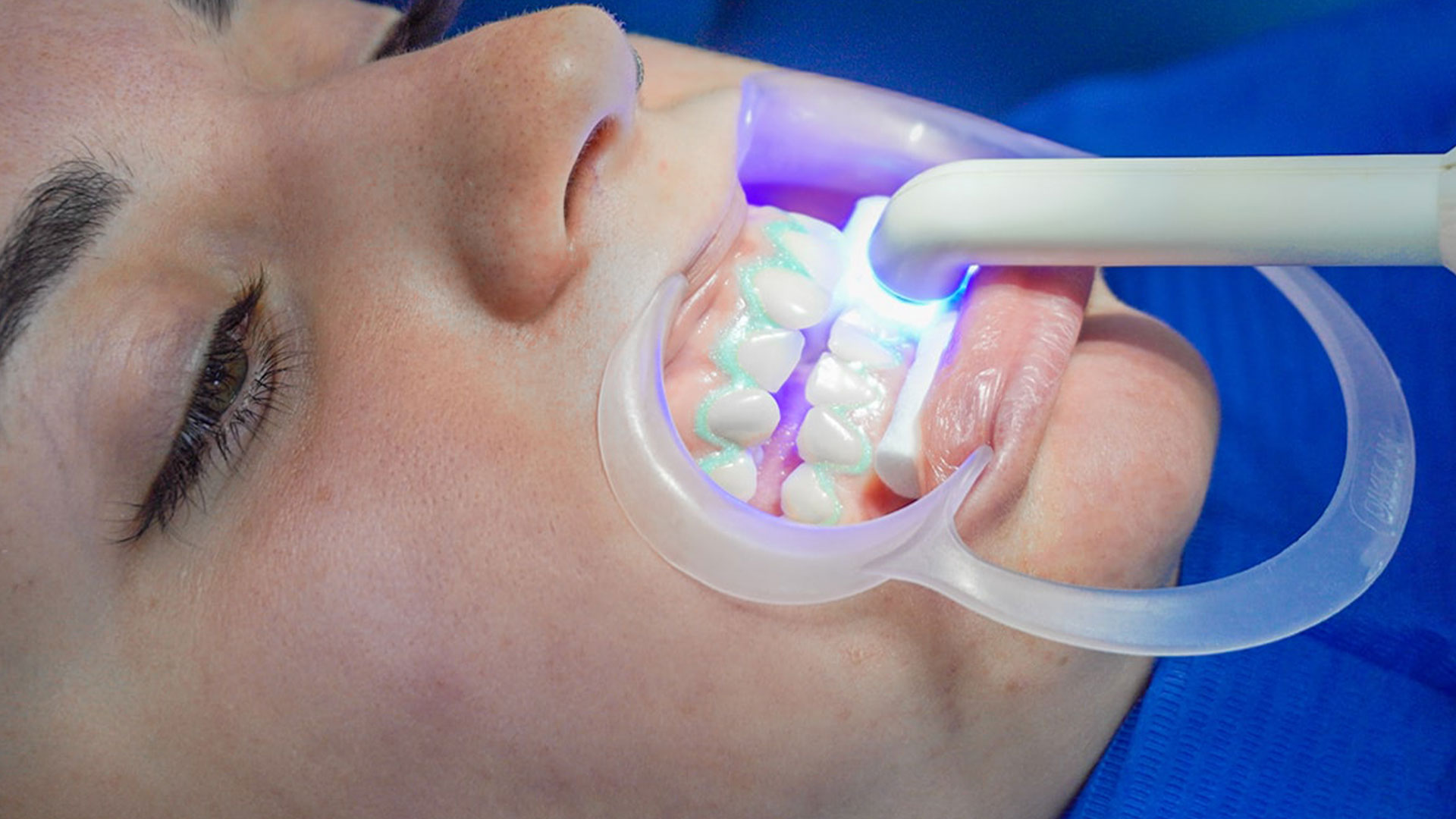 sbiancamento dental extra dentista 1