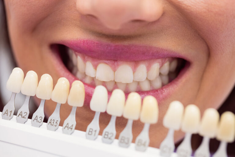 Ingiallimento denti : cura e prevenzione